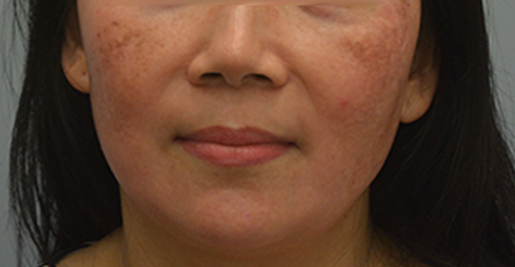 Có thể gây mẩn ngứa khi điều trị tàn nhang bằng laser